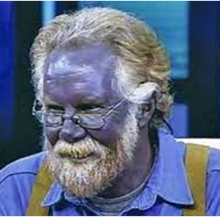 пол карасон синий человек. аргироз пол карасон. синий человек пол карсон. кожа стала синей. пауль карасон болезнь.