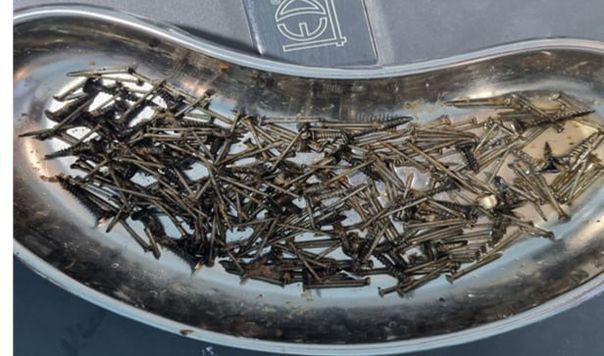 Samarqandlik shifokorlar bemor qornidan 200 gramm mix oldi